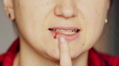 Dudağında acı veren uçuklara dokunan bir kadının yakın çekimi. Virüs enfeksiyonu, dermatoloji ve sağlık hizmetleri kavramı.