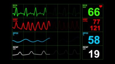 Hastane tiyatrosunda kalp atış hızı monitörü. Anestezi cerrahi monitörüne bağlı bir hastanede tıbbi hayati göstergeler monitörü. EKG. Hasta kalp atışı ekranda.