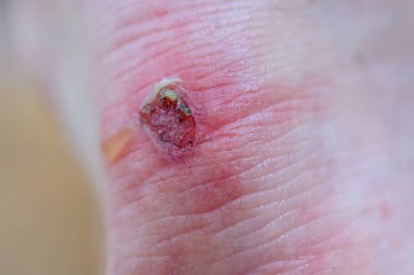 Erkeğin topuğunda büyük kanlı nasırlar var. Erkek ayağı..