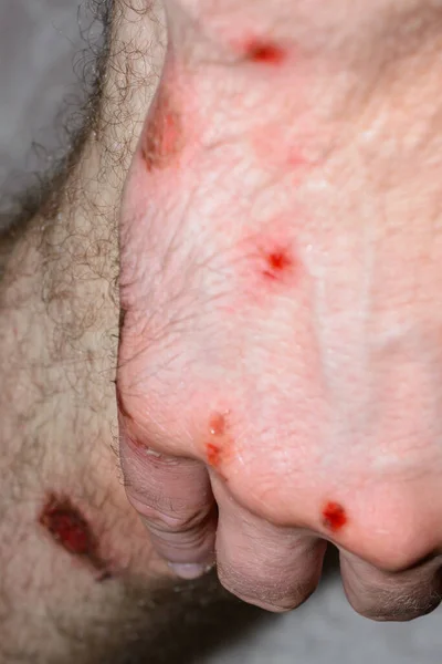 Rany Nodze Ręce Czerwony Krwawy Bolesny Uraz Spowodowany Upadkiem Podczas — Zdjęcie stockowe
