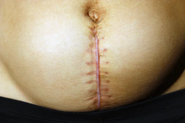 Seams after the operation of Caesarian section — Stock Photo, Image