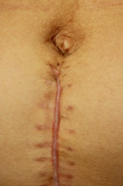 Sezaryen bölüm işleminden sonra dikişleri