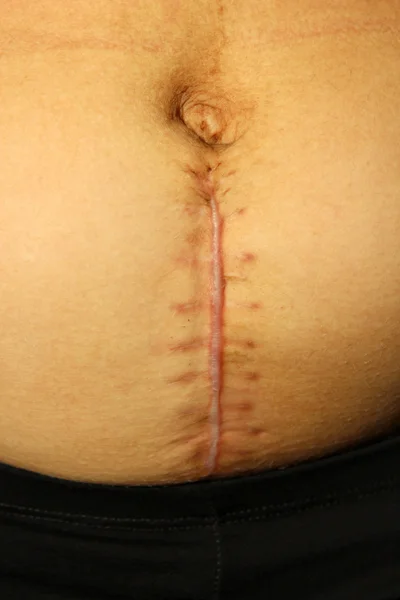 Seams after the operation of Caesarian section — Stock Photo, Image