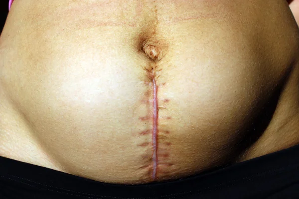 Costuras após a operação de cesariana seção — Fotografia de Stock