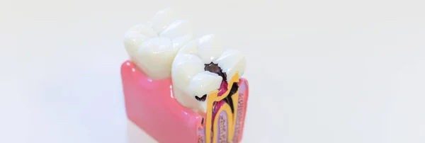 Dental verval model toont vooruitgang van verval. Een voorbeeld van tandheelkundige ziekte. Tandheelkunde. Caries op de tand. Ontsteking van de zenuwen van de tand.Kopieer ruimte. web banner — Stockfoto