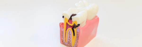 Dental decay model shows progress of decay.An example of dental disease. Dentistry. Caries on the tooth. Inflammation of the nerves of the teeth.Copy space. web banner