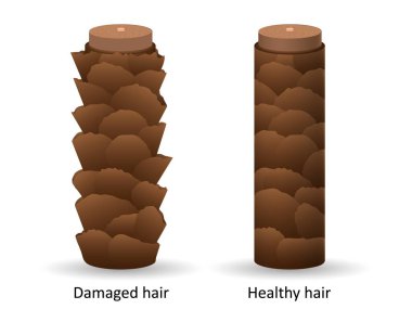 Hasarlı ve sağlıklı saçlar mikroskop altında. Dermatit ve alopecia areata ile kahverengi pullu yapı kafa biti ve vektör mantarı riski.