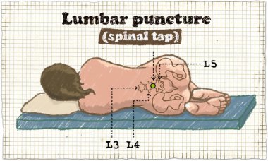 Lumbar puncture illustration clipart