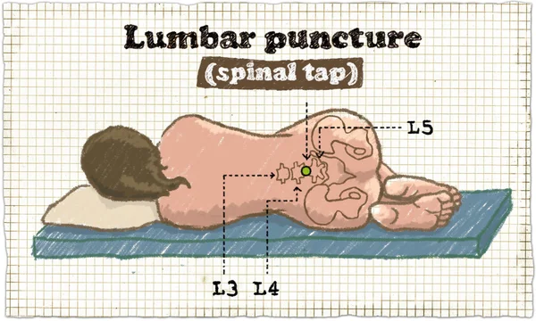 Lumbar puncture illustration — Stock Photo, Image