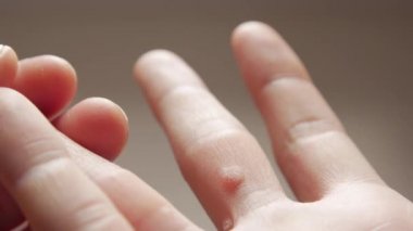 Parmaklarda Dermatolojik Hastalıklar