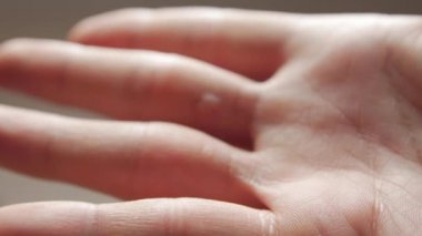 Siğiller Kapanışı