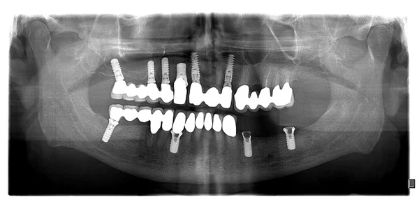 Dental x-ray with periodontitis problems — Stock Photo, Image