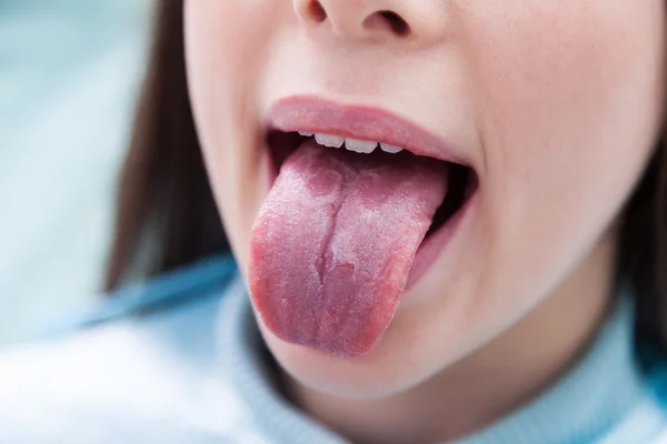 Geographic tongue. Dentist Office. — Stock Photo, Image