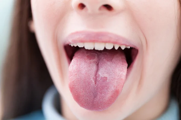 Geographic tongue. Dentist Office. — Stock Photo, Image