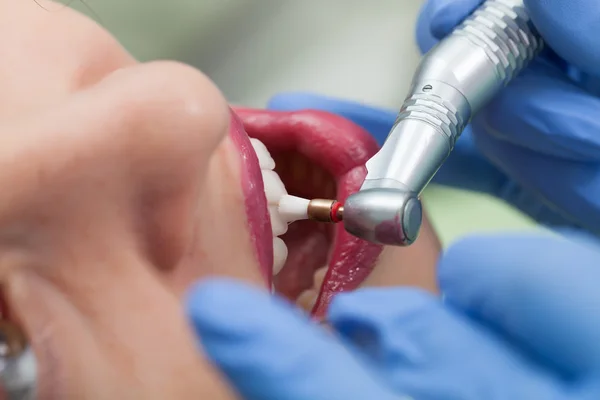 Close-up medical dentist procedure of teeth polish — Stock Photo, Image