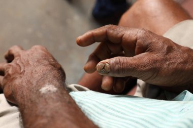 Indian Farmer Damaged Fingers