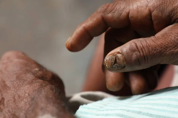 Indický Farmář Poškozené Prsty Kožní Onemocnění — Stock fotografie