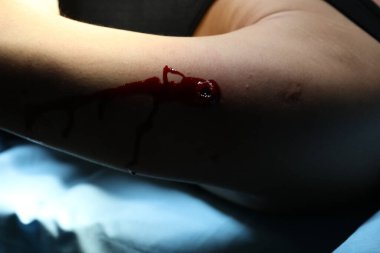 Bir elde kurşun yarası.