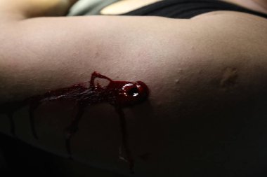 Bir elde kurşun yarası.