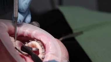 Diş kliniğinde diş tellerini temizliyorum. Modern ortodonti. Tıbbi sandalyedeki hasta..