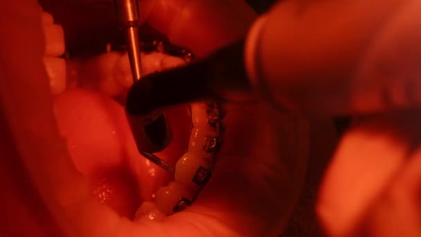 Installatie van beugelsystemen. Patiënt in de tandartsstoel. Moderne orthodontie. Close-up — Stockvideo