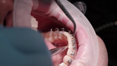 Parantez sistem kurulum süreci. Dişçi koltuğundaki hasta. Modern ortodonti. Yakın plan.