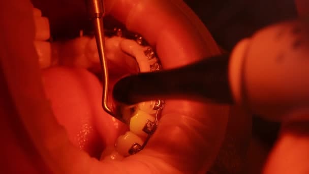 Proces montażu wsporników. Pacjent na krześle dentystycznym. Nowoczesna ortodoncja. Zbliżenie — Wideo stockowe