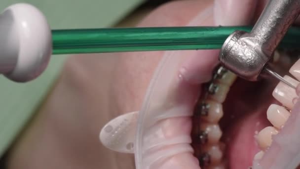 Processo di rimozione dell'apparecchio. Lucidatura dei denti. Paziente sulla sedia dentale. Ortodonzia moderna. Denti belli lisci — Video Stock