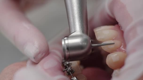 교정기를 제거하는 과정. 치아 광택. 치과 의자에 앉아 있는 환자. 현대 치과 의사들 이지. 매끄러운 아름다운 치아 — 비디오