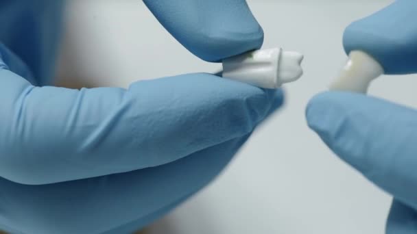Zahnfurniere schließen sich in den Händen des Arztes. Moderne Kieferorthopädie — Stockvideo