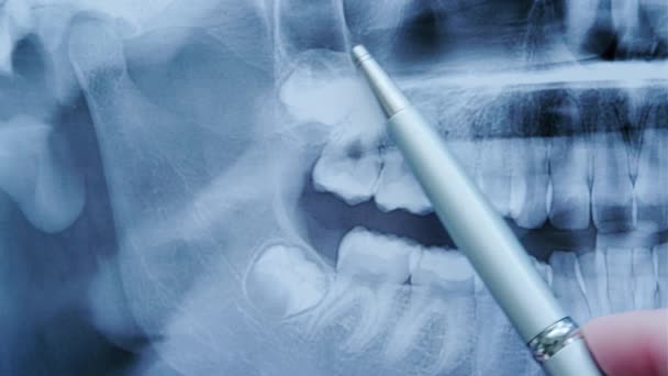 Οδοντίατρος εξετάζει μια πανοραμική ακτινογραφία των δοντιών δείχνει το πρόβλημα των δοντιών στην ακτινογραφία των δοντιών. — Αρχείο Βίντεο