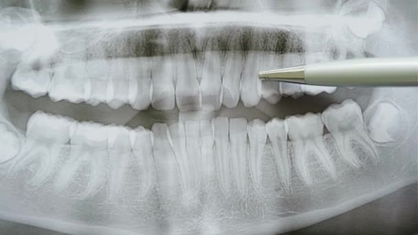 Close up view of Dentist εξετάζει μια πανοραμική ακτινογραφία των δοντιών δείχνει το πρόβλημα των δοντιών στην ακτινογραφία των δοντιών. — Αρχείο Βίντεο