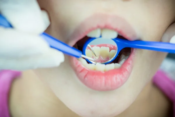 Nahaufnahme medizinischer Zahnarzt Verfahren des Polierens der Zähne mit sauberen — Stockfoto