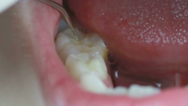 HD Riprese da vicino di dentista pulizia dei denti e il controllo con strumento di rimozione della placca — Video Stock