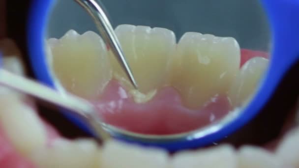 HD Filmación de cerca de los dientes de limpieza del dentista y la comprobación con la herramienta removedor de placa — Vídeos de Stock