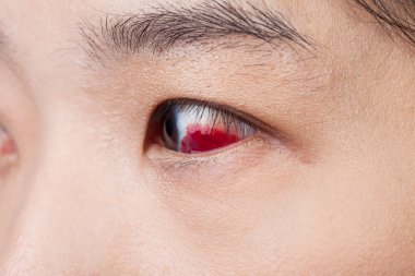 Göz yaralanması ya da sağlıklı kavramı, makro closeup enfekte 