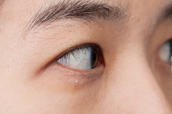 Lesão ocular ou infectada por conceito saudável, macro close-up — Fotografia de Stock