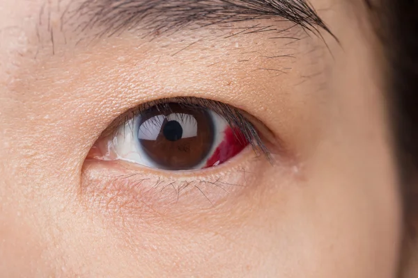 Lesão ocular ou infectada por conceito saudável, macro close-up — Fotografia de Stock