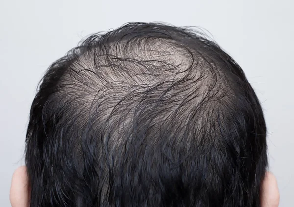 Zamknij Głowę Człowieka Wypadaniem Włosów Przerzedzenie Włosów Lub Łysienie Odizolowane — Zdjęcie stockowe