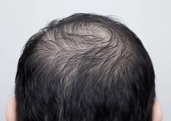 Cierre Cabeza Del Hombre Con Pérdida Cabello Adelgazamiento Del Cabello Fotos De Stock