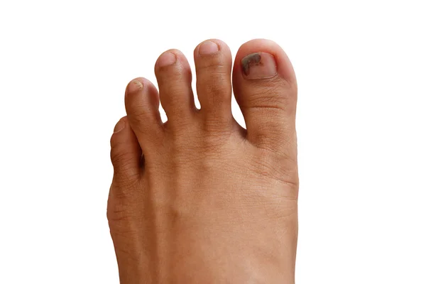 Foot with bruise on nails isolated on white background — Stock Photo, Image