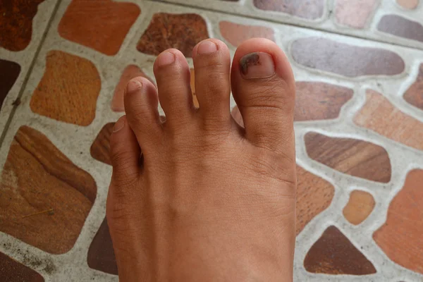Fuß mit Prellung an den Nägeln — Stockfoto