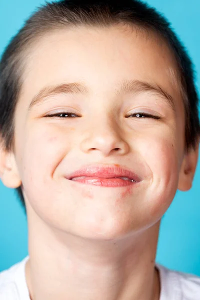 Portrait Cheerful Smiling Boy Mild Perioral Dermatitis Blue Background — Fotografia de Stock