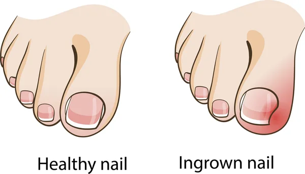 Ingegroeide nagel — Stockvector