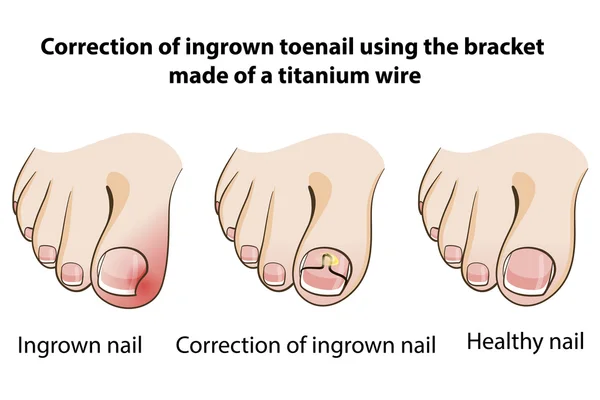 Unha Ingrown —  Vetores de Stock