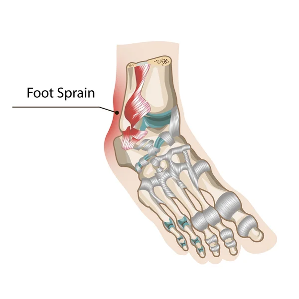 Entorse du pied — Image vectorielle