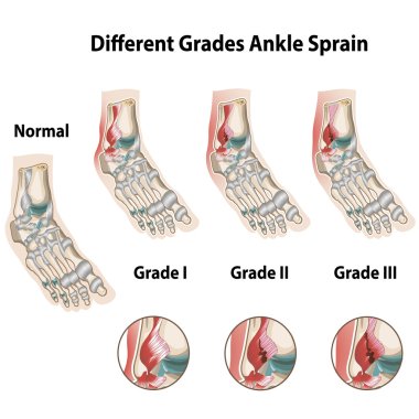  Grades of ankle sprains clipart