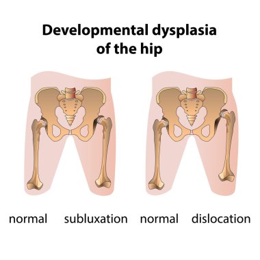 Dysplasia of the Hip clipart