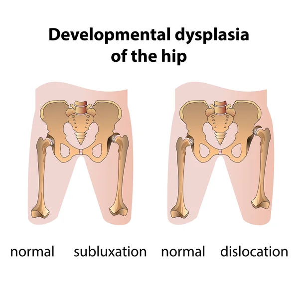 Dysplasie de la hanche — Image vectorielle