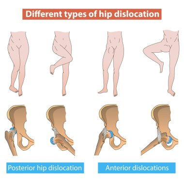 Hip dislocation clipart